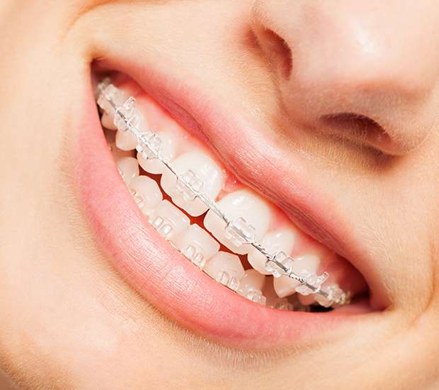 Clear Braces Ventura, CA, Brighton Specialty Dental Group, Nearly  Invisible Braces